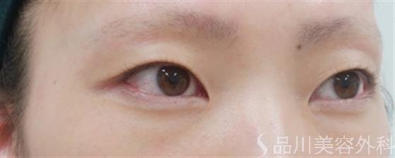 症例NO.30078のBEFORE写真