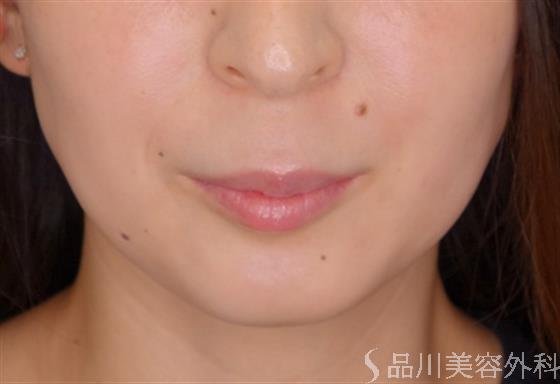 症例NO.52331のBEFORE写真