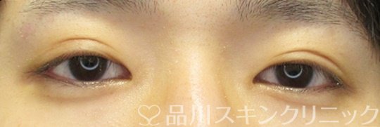 症例NO.70015のAFTER写真
