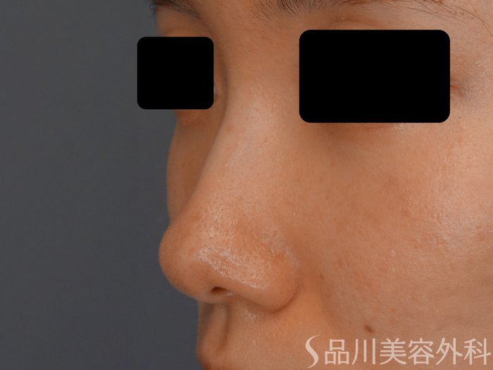 症例NO.65461のBEFORE写真