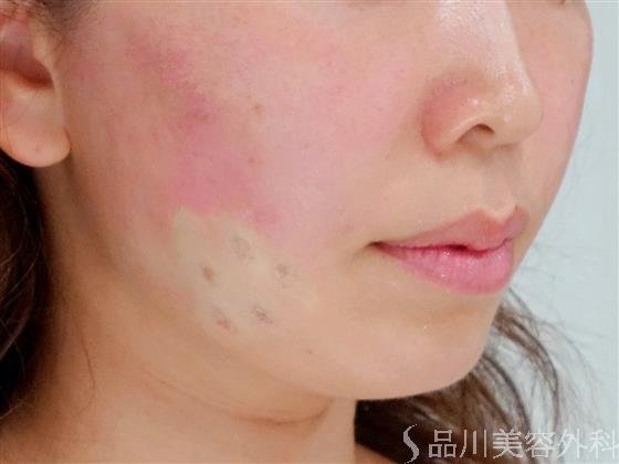症例NO.30365のAFTER写真