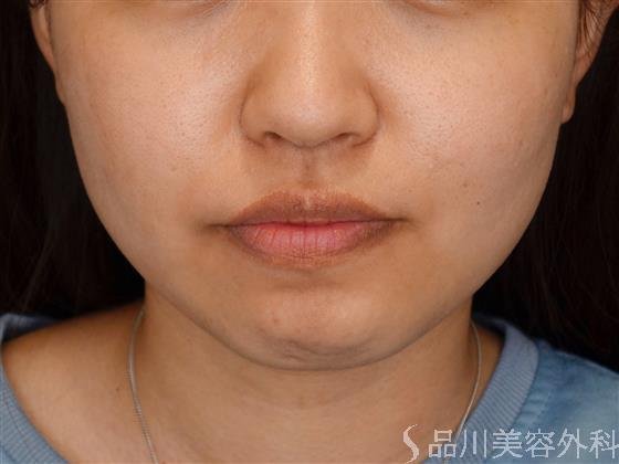 症例NO.51066のBEFORE写真