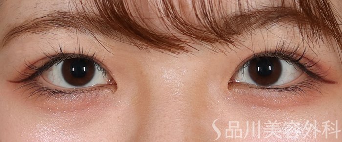 症例NO.71530のAFTER写真