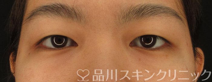 症例NO.63158のBEFORE写真