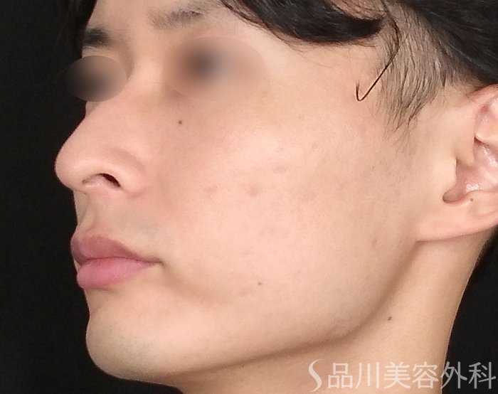 症例NO.67499のAFTER写真