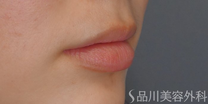 症例NO.69243のBEFORE写真