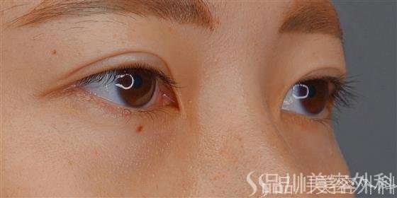 症例NO.72321のAFTER写真