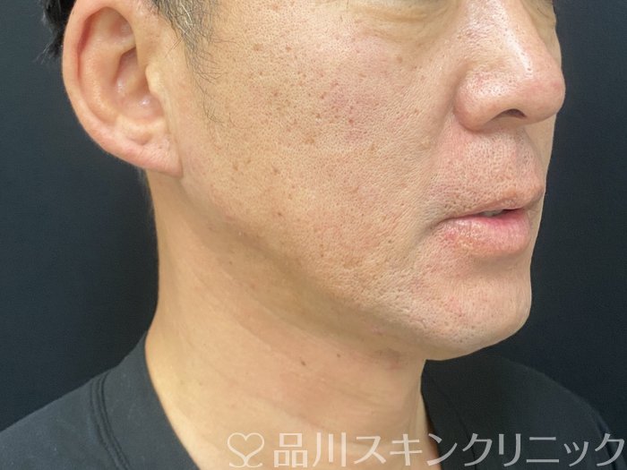 症例NO.73926のAFTER写真