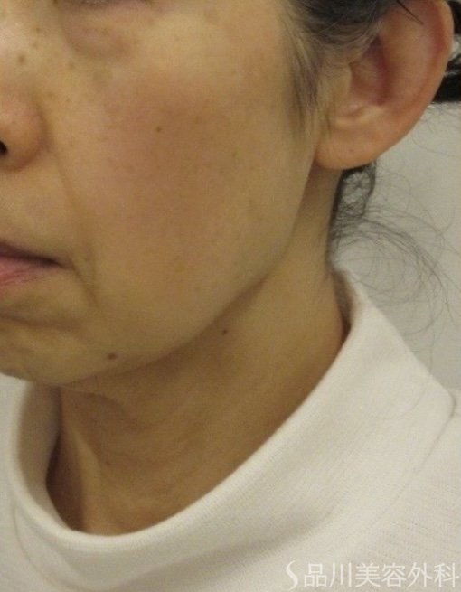 症例NO.75161のBEFORE写真