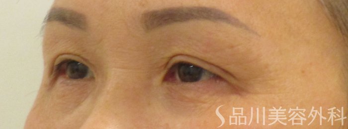 症例NO.64979のBEFORE写真