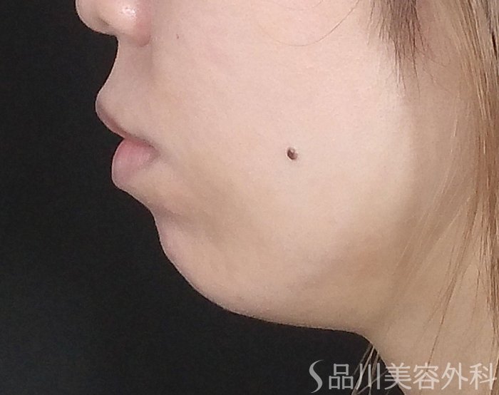 症例NO.65453のBEFORE写真
