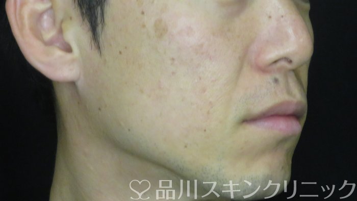 症例NO.70913のBEFORE写真