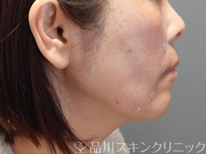 症例NO.69479のAFTER写真