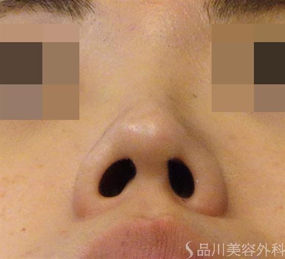 症例NO.40101のAFTER写真