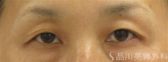症例NO.55901のBEFORE写真