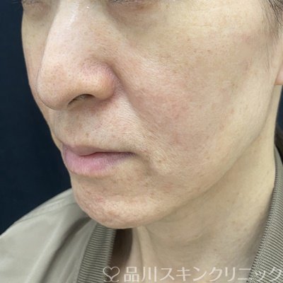 症例NO.62874のBEFORE写真