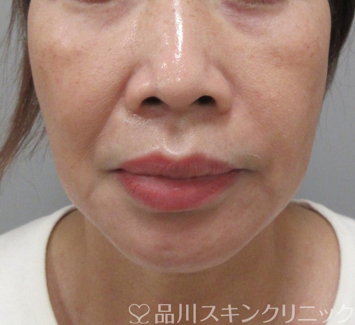 症例NO.74459のBEFORE写真