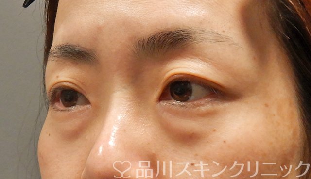 症例NO.68167のBEFORE写真