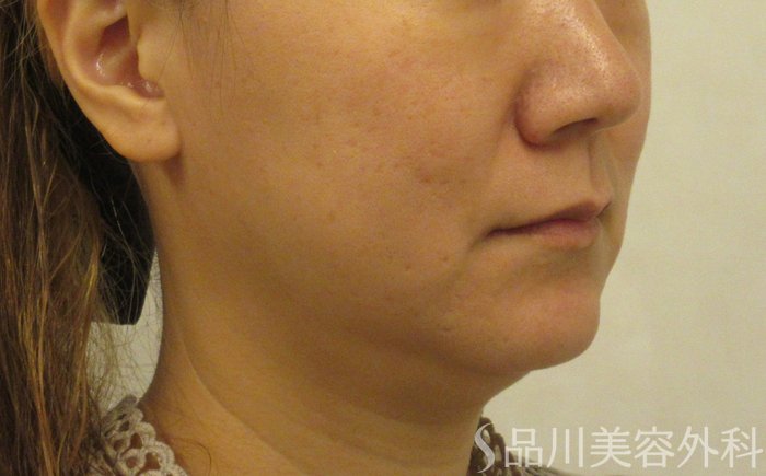 症例NO.71577のBEFORE写真