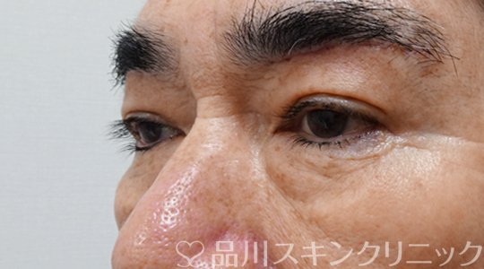症例NO.69799のAFTER写真