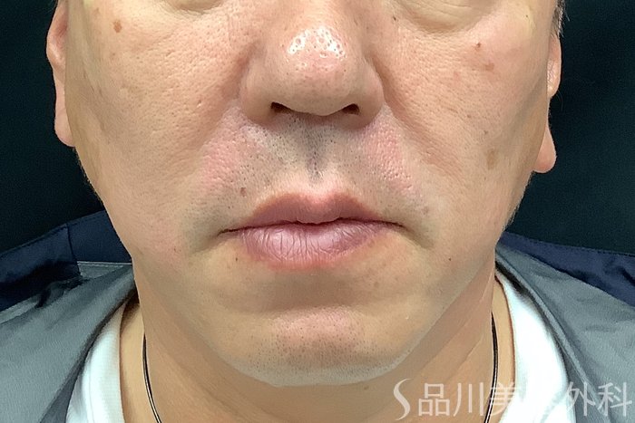 症例NO.73308のAFTER写真