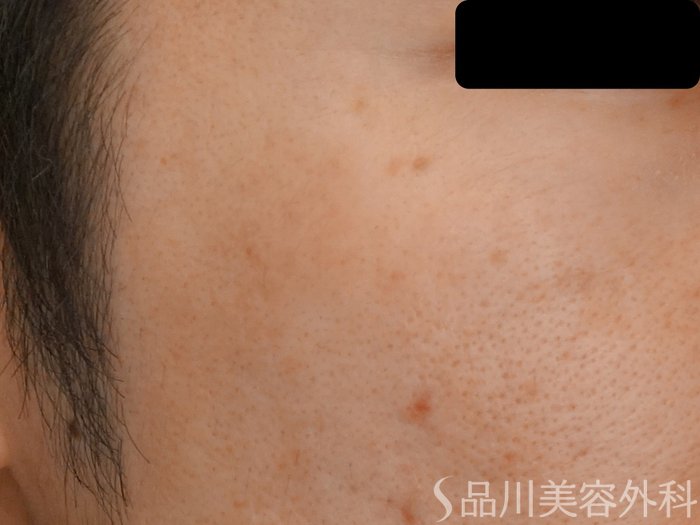 症例NO.69450のAFTER写真