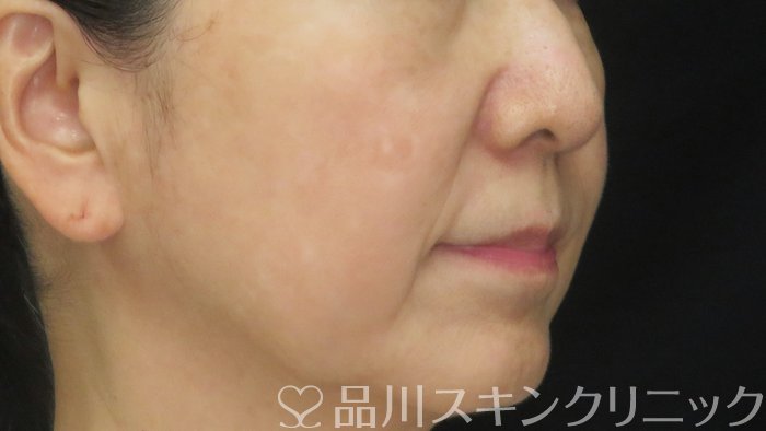 症例NO.72014のBEFORE写真