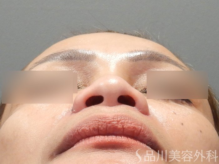 症例NO.74188のAFTER写真