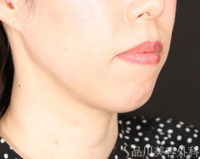 症例NO.71031のBEFORE写真
