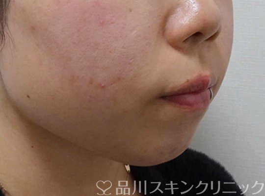 症例NO.64622のBEFORE写真
