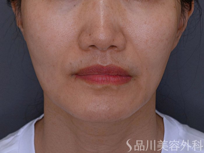 症例NO.74690のBEFORE写真