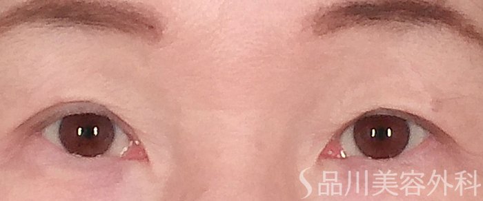 症例NO.69375のAFTER写真