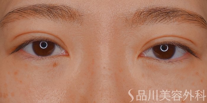 症例NO.73527のAFTER写真