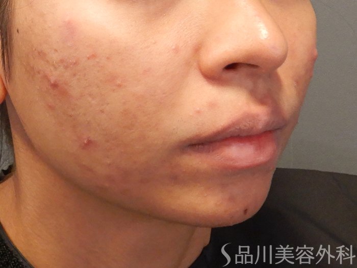 症例NO.70713のBEFORE写真