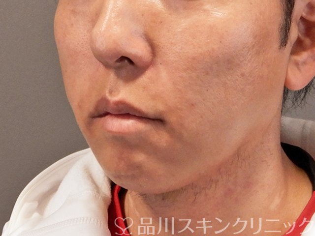 症例NO.70490のAFTER写真
