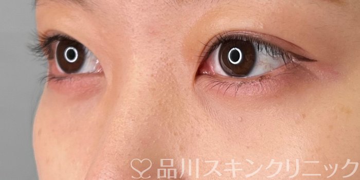 症例NO.69879のAFTER写真