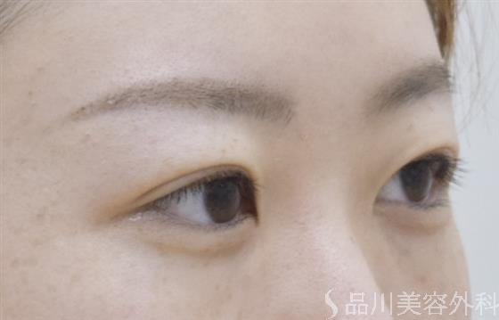 症例NO.54041のAFTER写真