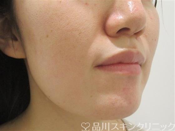 症例NO.38016のBEFORE写真