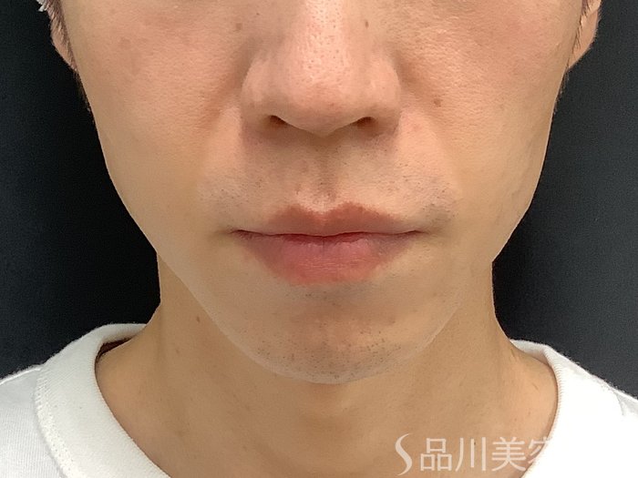 症例NO.67654のBEFORE写真