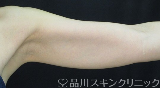 症例NO.71721のBEFORE写真