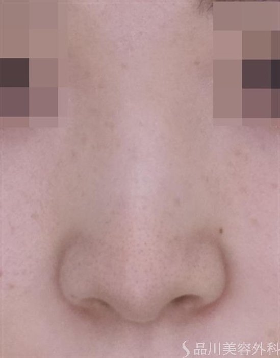 症例NO.49318のBEFORE写真