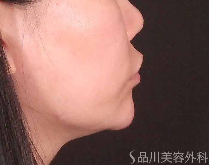 症例NO.69994のAFTER写真