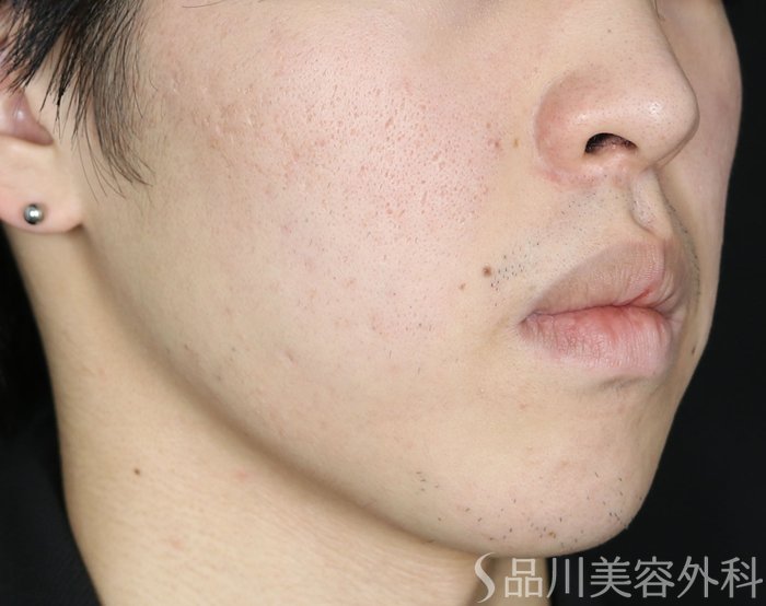 症例NO.73066のBEFORE写真