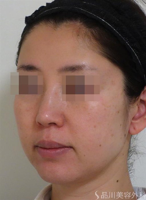症例NO.41324のBEFORE写真