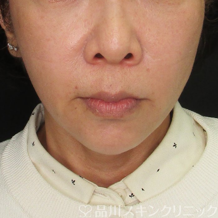症例NO.69673のAFTER写真