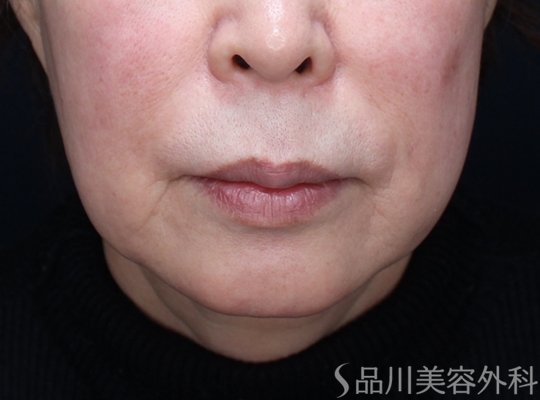 症例NO.73015のBEFORE写真