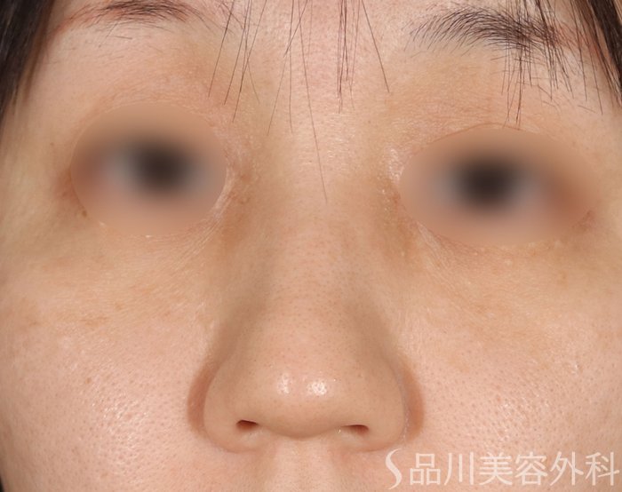 症例NO.72589のBEFORE写真