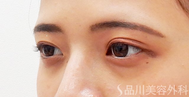 症例NO.62350のBEFORE写真