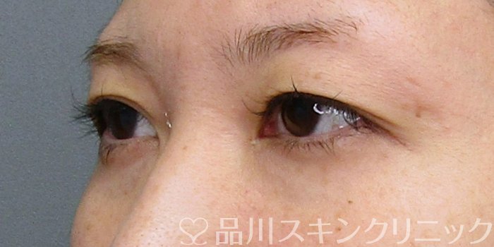 症例NO.75023のBEFORE写真