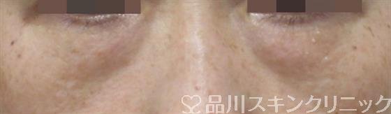 症例NO.34301のBEFORE写真